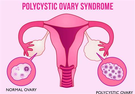 PCOS and their symptoms. – Nutrisage India