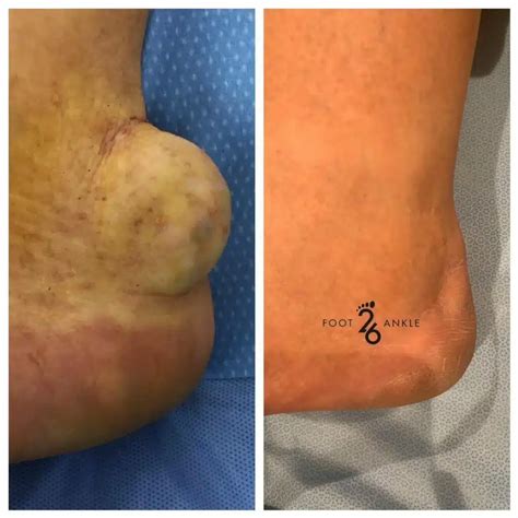 Soft Tissue Mass Removal: Ganglion Cyst - 26 Foot & Ankle