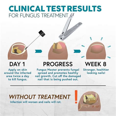 Buy Ebanel Foot Fungus Treatment Extra Strength Athletes Foot Cream ...