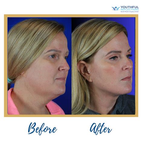 Joyce meyer s plastic surgery journey before after – Artofit