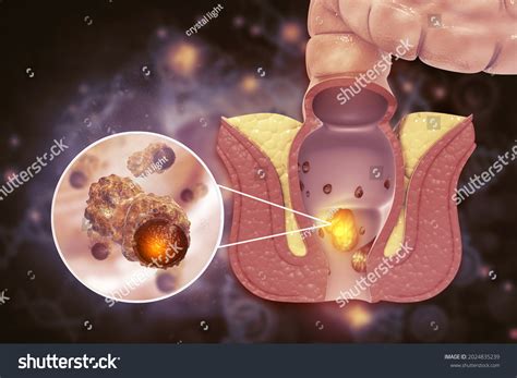 Haemorrhoids Piles On Scientific Background 3d Stock Illustration ...