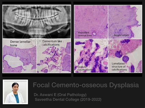 Focal COD — ORAL PATHOLOGY-SAVEETHA