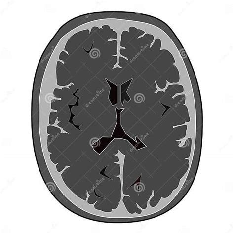 Image result for Normal Brain CT Scan Head