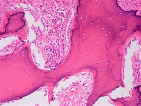 Ossifying Fibroma Histology