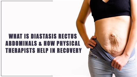 What is Diastasis Rectus Abdominals & How Physical Therapists Help in Recovery? - Oklahoma ...