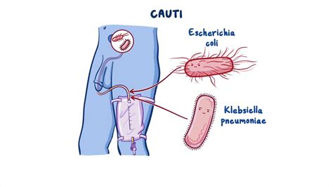 Catheter Associated Urinary Tract Infection Cauti