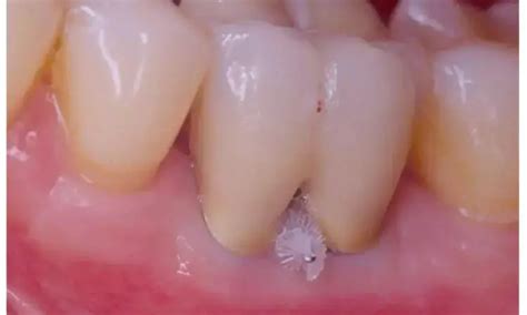 Furcation involvement in molars strongly associated with molar loss