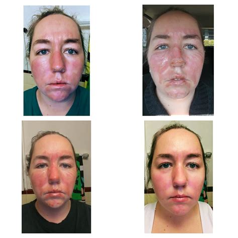 First Degree Burn Face