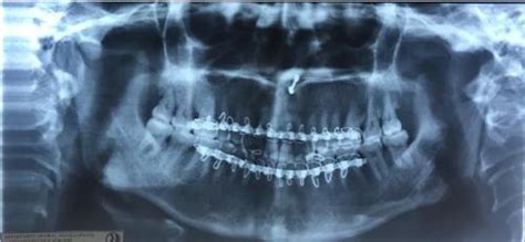 Osteochondroma of the left condylar head- Case Report - IP Int J ...