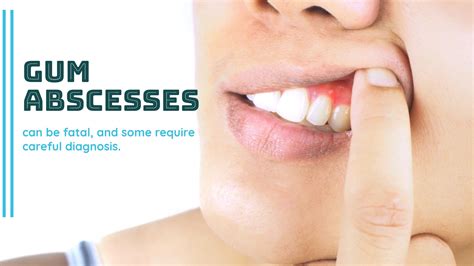 Gum Abscess Popped?: Causes, Symptoms, and Treatment Options