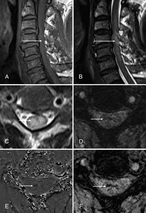 Susceptibility-weighted Imaging: Technical Essentials and Clinical Neurologic ApplicationsRadiology