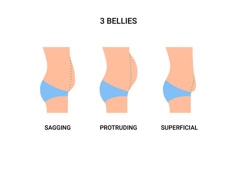 Types bellies of human body, big belly with overweight. Sagging, protruding and superficial ...