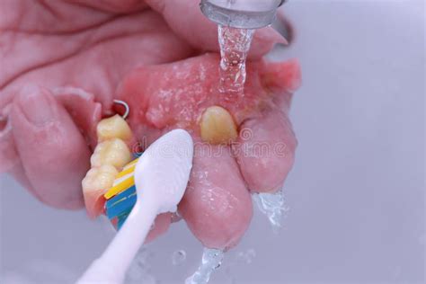 Image result for How to Clean Front Teeth Partials