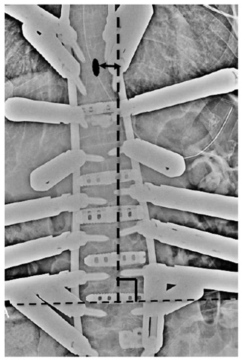 New Effective Intraoperative Techniques for the Prevention of Coronal ...