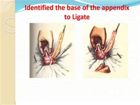 Image result for Appendicitis Assessment Signs