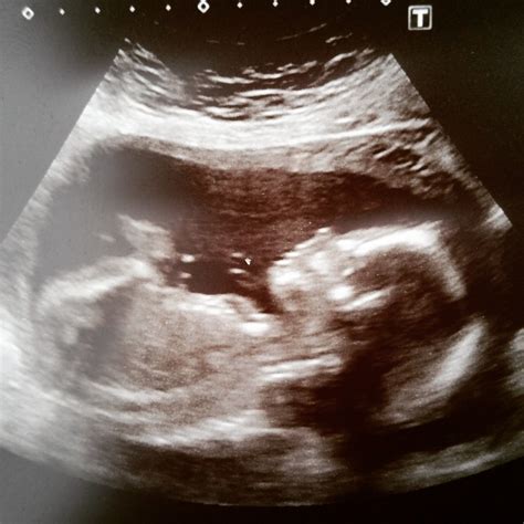My Pregnancy - The 20 Week Scan - Flourish With Holly