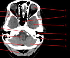 CT Brain AXIAL images Flashcards | Quizlet