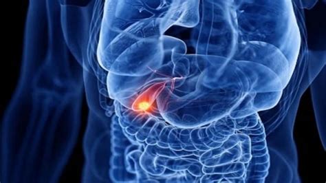 Foods To Avoid During Gallbladder Stone:গলব্লাডার স্টোনের অপারেশন ...