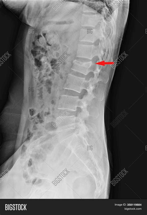 Lateral Lumbar Spine Xray