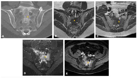 Beyond Chordoma: A Comprehensive Review of Sacral Lesions