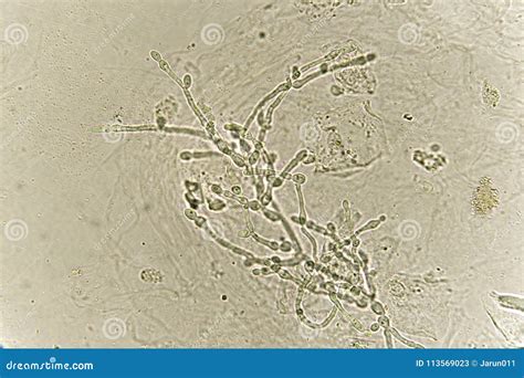 Pseudohyphae and Budding Yeast Cells in Patient Urine Stock Image ...