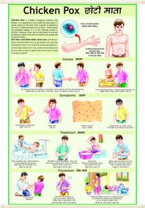 Chicken Pox Disease Lamination Chart in English / Hindi combined ...