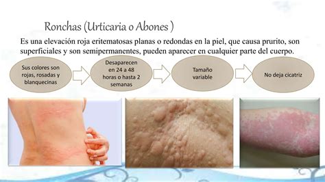 lesiones de la piel ronchas y vesiculas.pptx