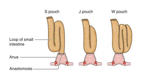 Image result for pouchoscopy