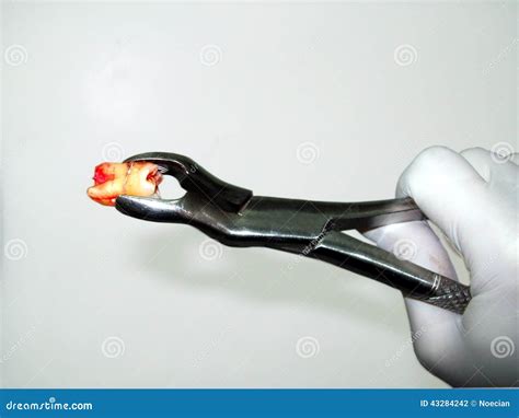 Forceps Dental Extraction and Freshly Extracted Molar Stock Photo - Image of molar, surgery ...