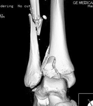 Large Awards Affirmed in Ankle Fracture RSD Case | New York Injury ...