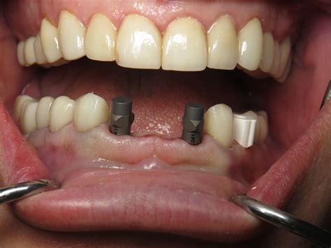 Immediate Implant Bridge Lower Jaw Front Teeth | Ramsey Amin, DDS