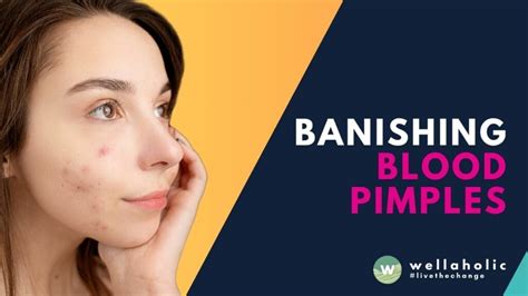 Image result for Blood Red Pimple