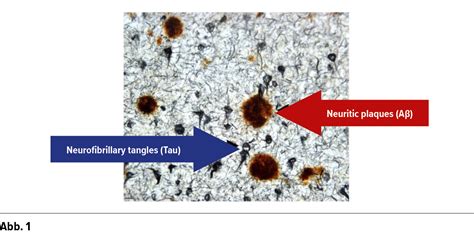 Imaging der Biomarker Amyloid beta und Tau in der Diagnostik kognitiver ...