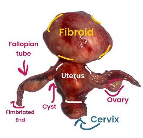 Pedunculated fibroid on uterus : r/MedicalGore