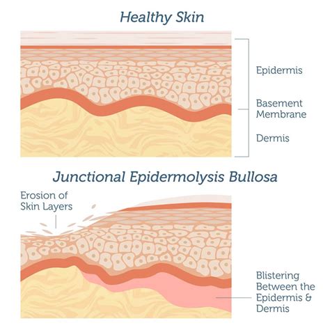 Junctional Epidermolysis Bullosa - Genebase