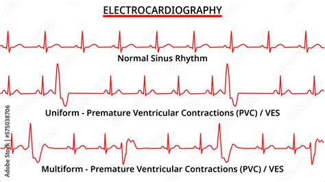 Image result for PVC ECG Reading