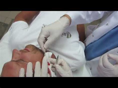 Largest Exploding Cyst 的图像结果