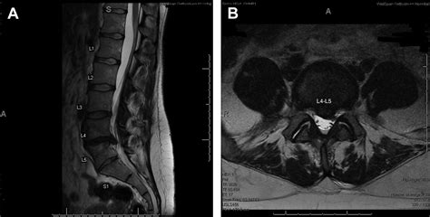 Lumbosacral Transitional Segments - Physical Medicine and ...
