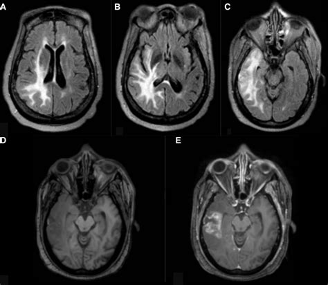 Whole brain radiation therapy resulting in radionecrosis: a possible link with radiosensitising ...