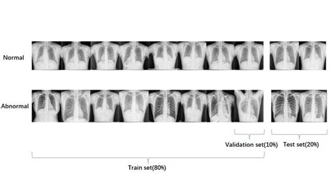 Image result for Tuberculosis Dataset CSV
