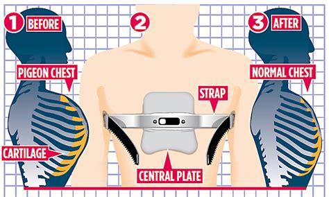 Pectus Carinatum Brace Before And After