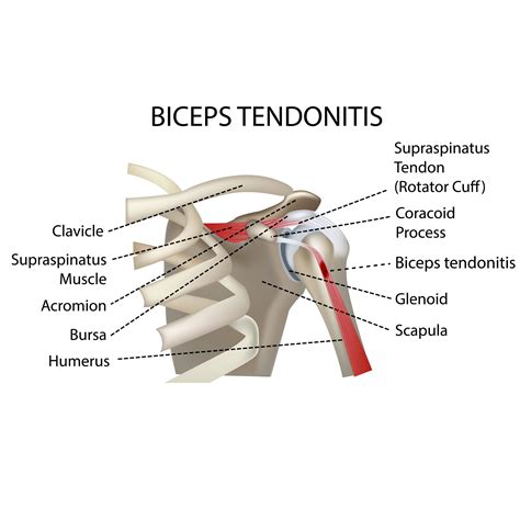 Biceps Femoris Tendinosis