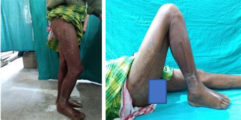 Fracture neck of femur: Outcome of results of fixation with 3 ...
