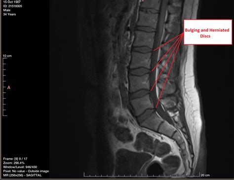 Herniated and Bulging Disc: Diagnosis, causes and treatments - Mr Salus Sporting Lab