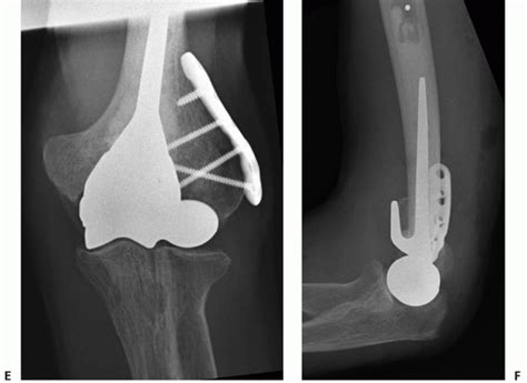 Image result for Open Reduction Distal Radius Fracture