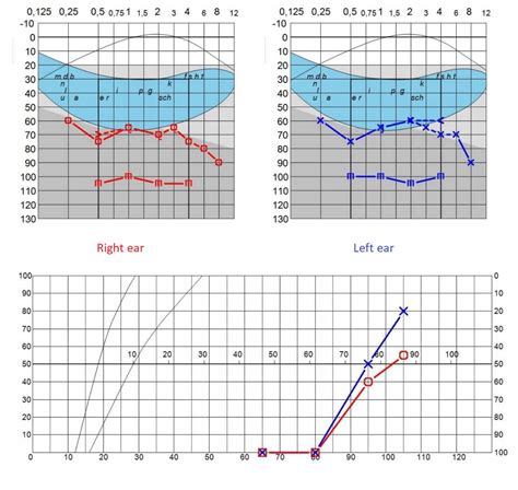 Audiogram Types and examples 的图像结果