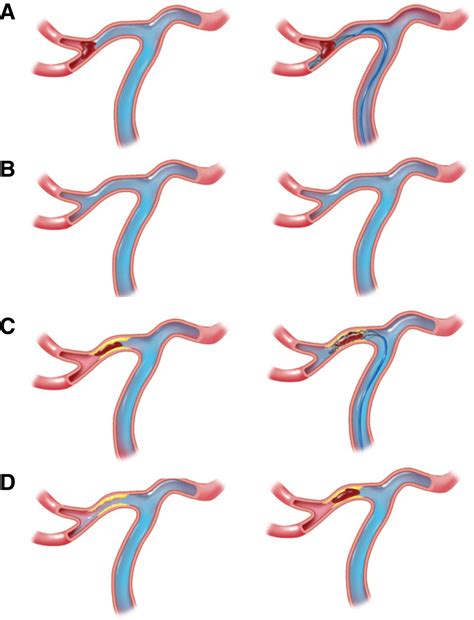 Large Vessel Occlusion Stroke due to Intracranial Atherosclerotic ...
