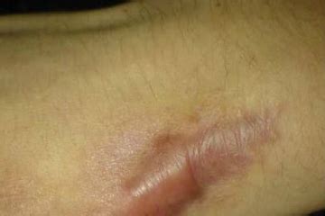 Acne Scar Treatment in Pune, best skin specialist in aundh