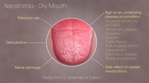 Xerostomia: Symptoms, Causes, and Treatment Xerostomia