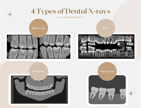 How Often Should You Get Xrays at the Dentist? DH Explains | Dental hygiene school, Doctor of ...